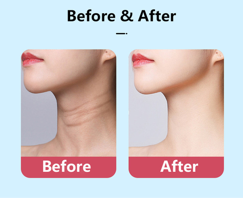 พลังงานระดับ 2.5W LED Therapy Neck Rejuvenation V-Face Lifting Massager สําหรับป้องกันการแก่ตัว